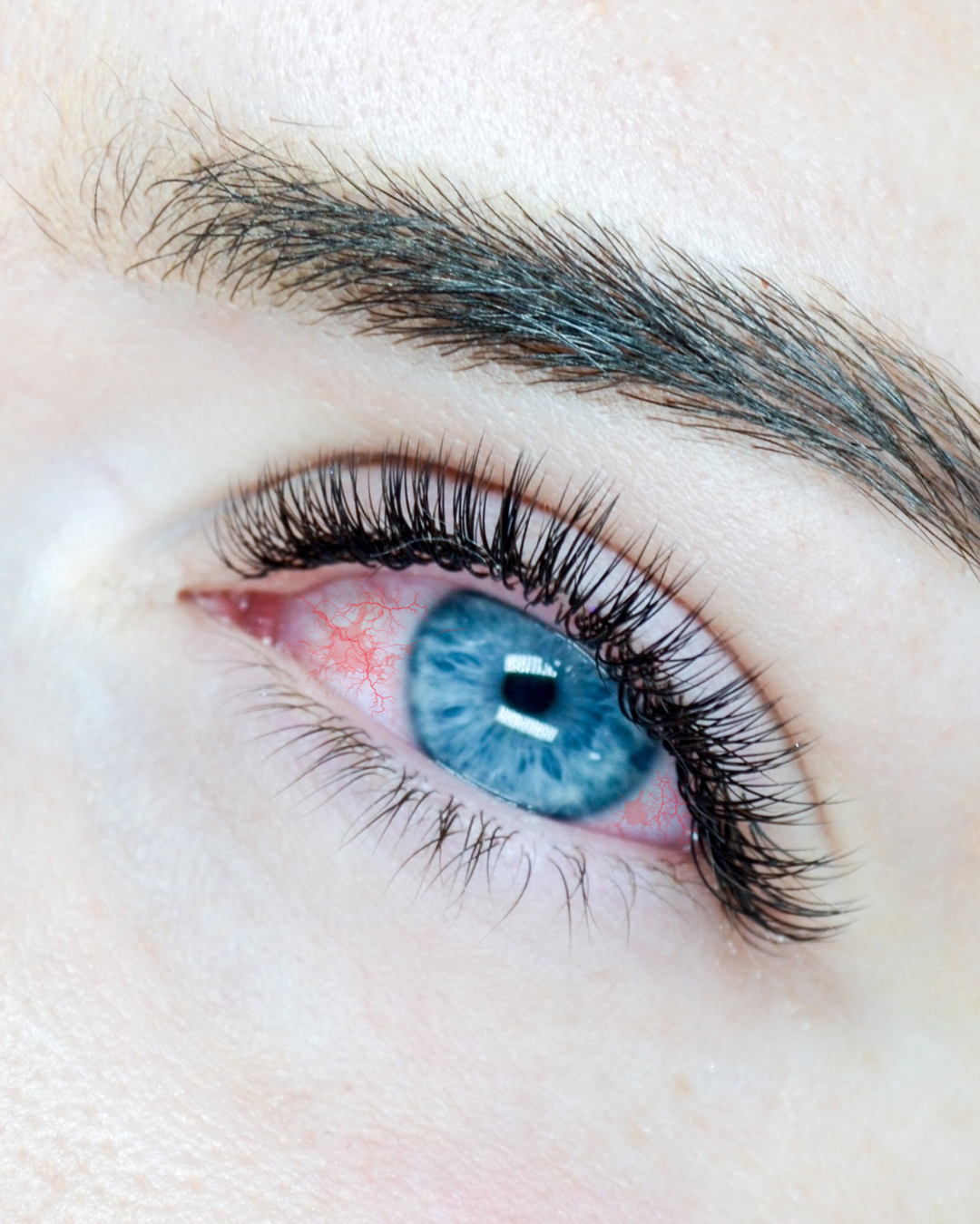 Chemical Burn in Eyelash Extensions